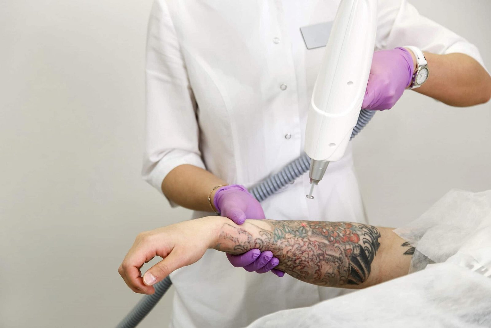 tattoo removal